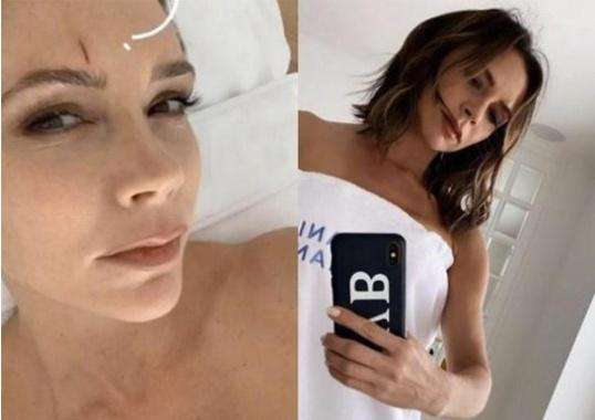 贝克汉姆受伤 贝克汉姆老婆滑雪意外受伤，躺病床上发性感自拍，受伤还这么美！