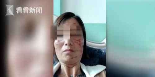 祛斑整形医院 女子在贵阳奥黛丽医疗整形医院祛斑失败竟变“妖怪” 还欠下高额美容贷