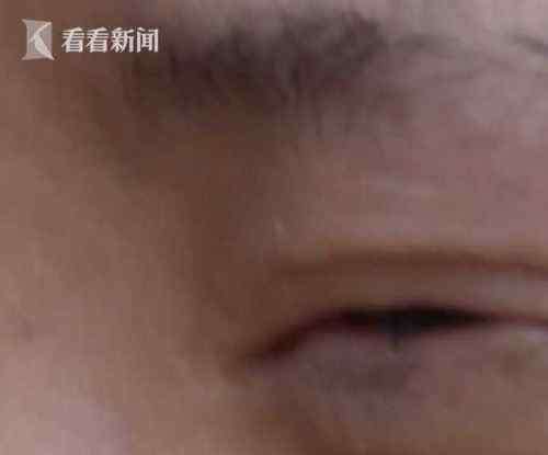 太原华美整形医院 18岁女孩在太原市华美整形医院做开眼角手术 结果眼睛再也闭不上了