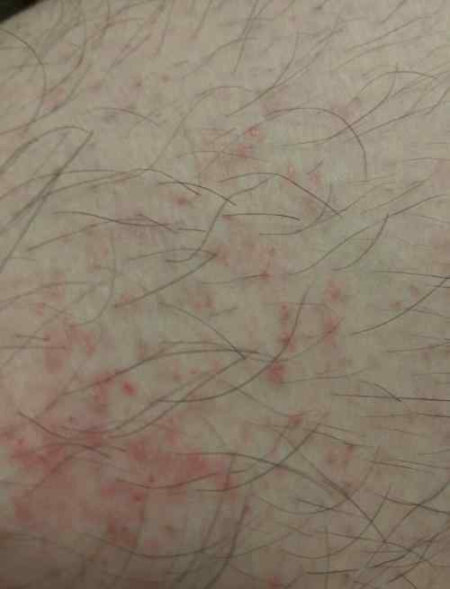 硬下钳的症状图片 毛囊炎和硬下钳怎么辨别？
