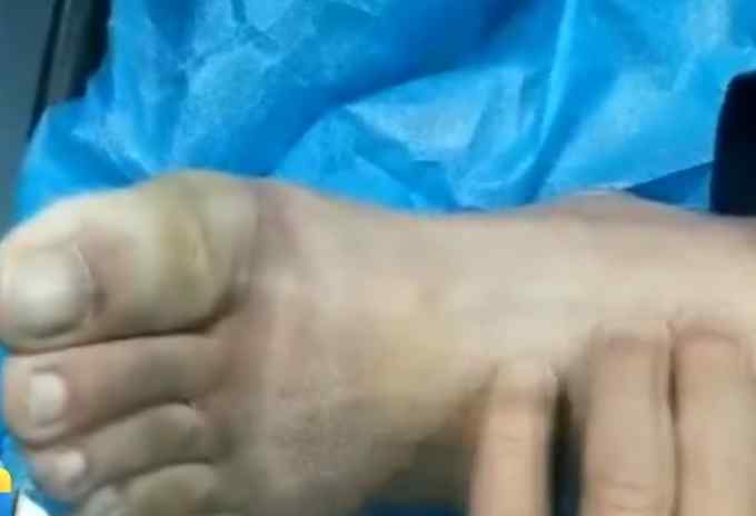 “脚比冰棍都凉” 大连男子醉酒街头被冻僵 手脚恐难保！