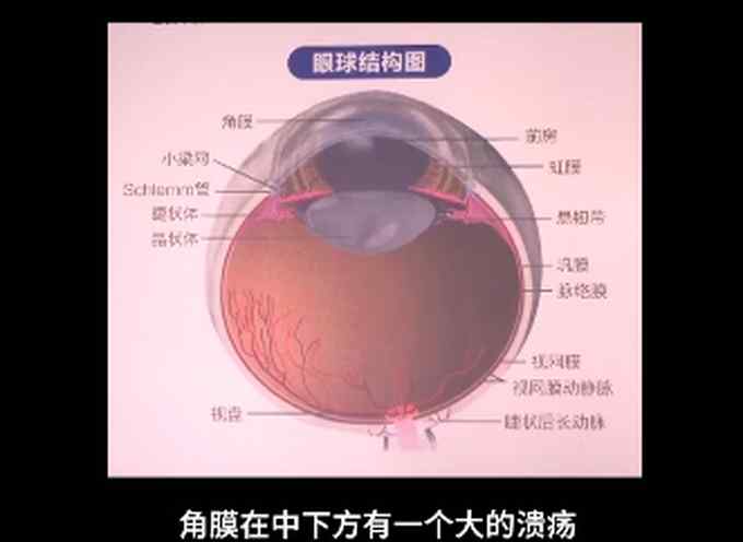 10岁男孩感染真菌眼角膜溃烂 医生：孩子经常抠脚后揉眼睛