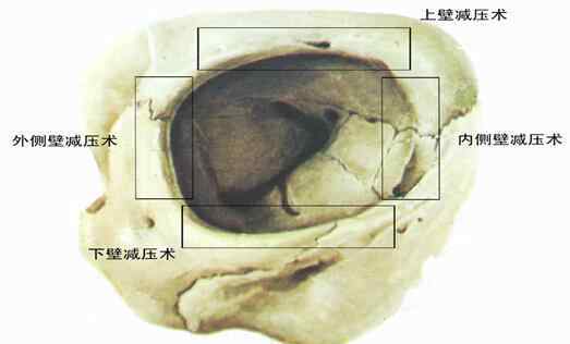 突眼症 夏氏EPS突眼矫正术——突眼症患者的福音