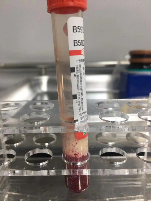 22岁女老师每天一杯奶茶 午休时突然晕倒小便失禁 抽的血都是乳白色