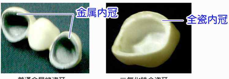 烤瓷牙套价格表 烤瓷牙的种类及价格！别被忽悠了！文章配图