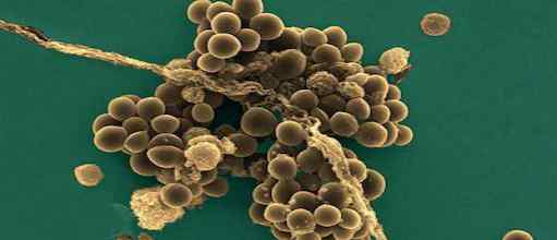 葡萄球菌肺炎 什么是金黄色葡萄球菌肺炎