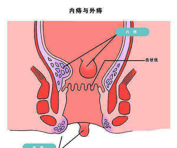 我被女s强制取精经历 女生经历痔疮手术，是一种怎样的体验！