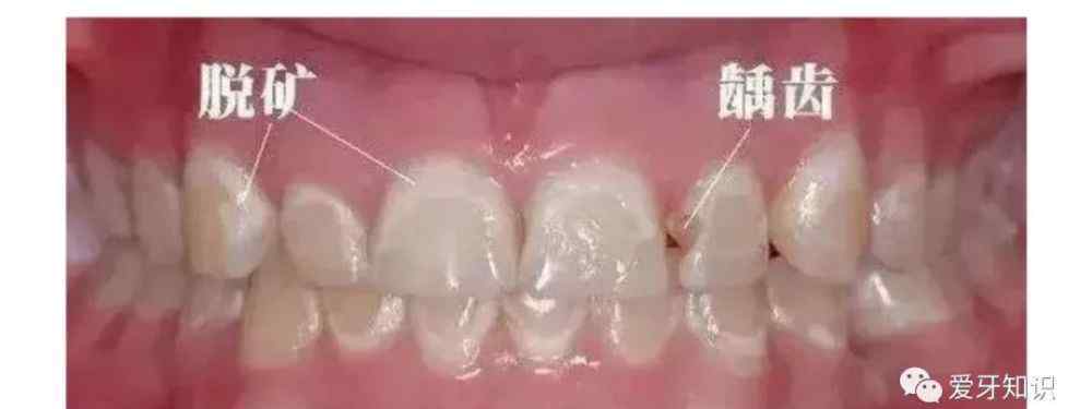 门牙上有白斑图片 一看吓一跳，牙齿上居然长白斑？要怎么处理？