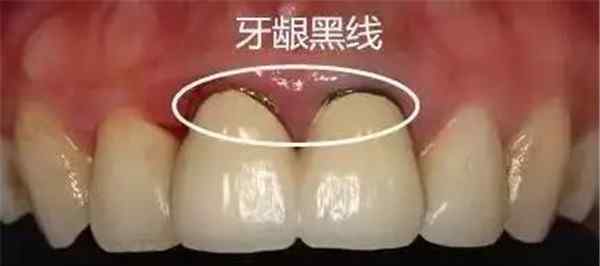 烤瓷牙和全瓷牙区别 烤瓷牙和全瓷牙的区别，你选错了吗？