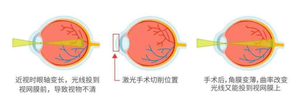 准分子激光手术后遗症 你以为做了手术，近视就好了？手术的后遗症，它终于出现了……