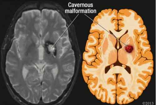 海绵状血管瘤严重吗 颅内海绵状血管瘤有什么特点，可能比想象中更严重，建议大家重视