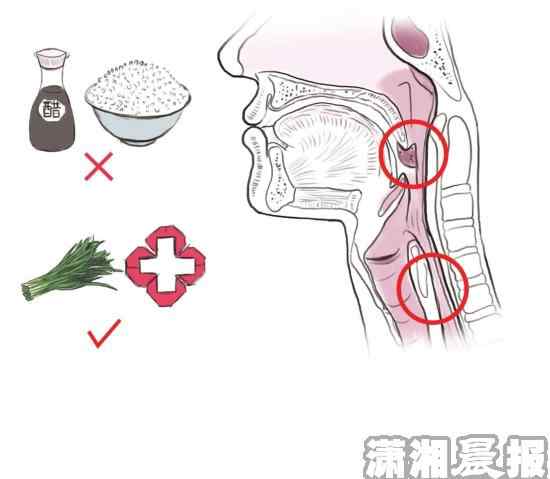 卡了鱼刺会自己消失吗 岳阳男子鱼刺卡食道没在意 13天后大出血身亡