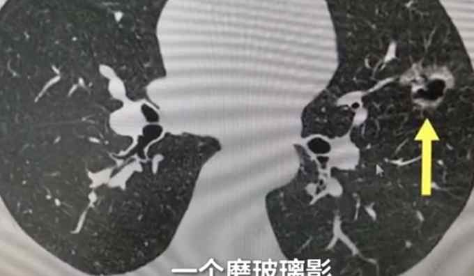 女子长期吸同事二手烟肺部长肿块 网友：室内抽烟的人太自私