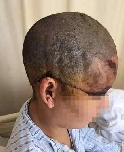 妙手医师 女子一头秀发连头皮被扯掉 14小时缝了200针