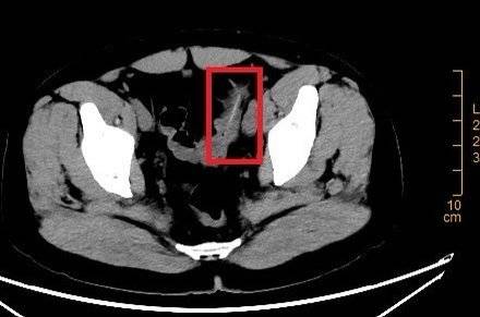 男子腹痛4个月后取出6厘米牙签 医生：这个习惯不可取！