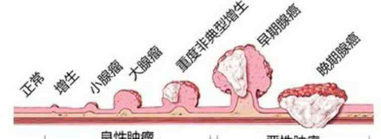 肠子长息肉最怕吃什么 肠息肉最怕吃什么？为什么？