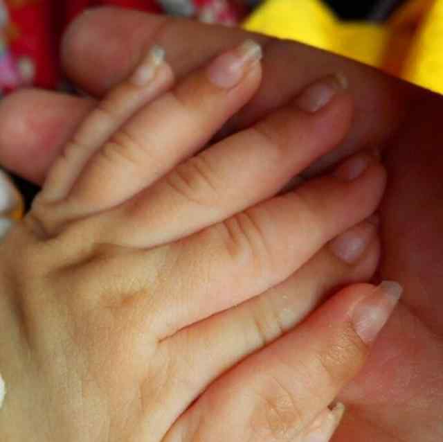 多指症 湖南一儿童患罕见多指症 共有31个手指脚趾