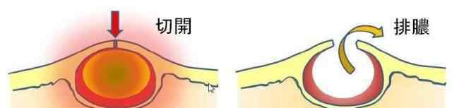 耳朵长了个硬包 耳朵后面长了个硬包是是什么？竟是一种病
