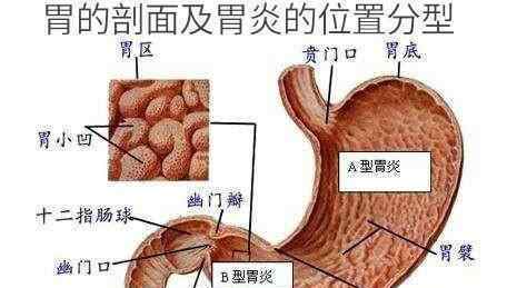 慢性非萎缩性胃炎伴糜烂 胃镜显示慢性非萎缩性胃炎伴糜烂，该怎么调养呢？