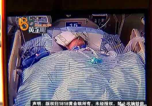修脚店拔出的肉刺图 女孩在修脚店处理鸡眼 却因此进了重症监护室