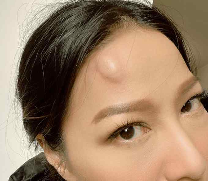 滕丽名老公 意外撞墙哭笑不得！44岁TVB女星滕丽名额头肿包隆起，却被富商老公当成故意化妆