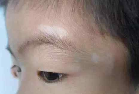 寄生虫白斑图片 孩子脸上起白斑，是食积吗？是肠道寄生虫吗？