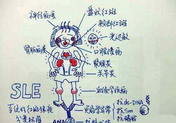 狼疮能治疗吗 屠呦呦被刷屏，系统性红斑狼疮真的能够根治吗？协和专家声称仍需冷静对待