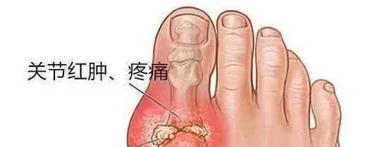 年轻人痛风死定了 痛风有多痛？53岁男子被活活疼死！这些食物一定要忌口