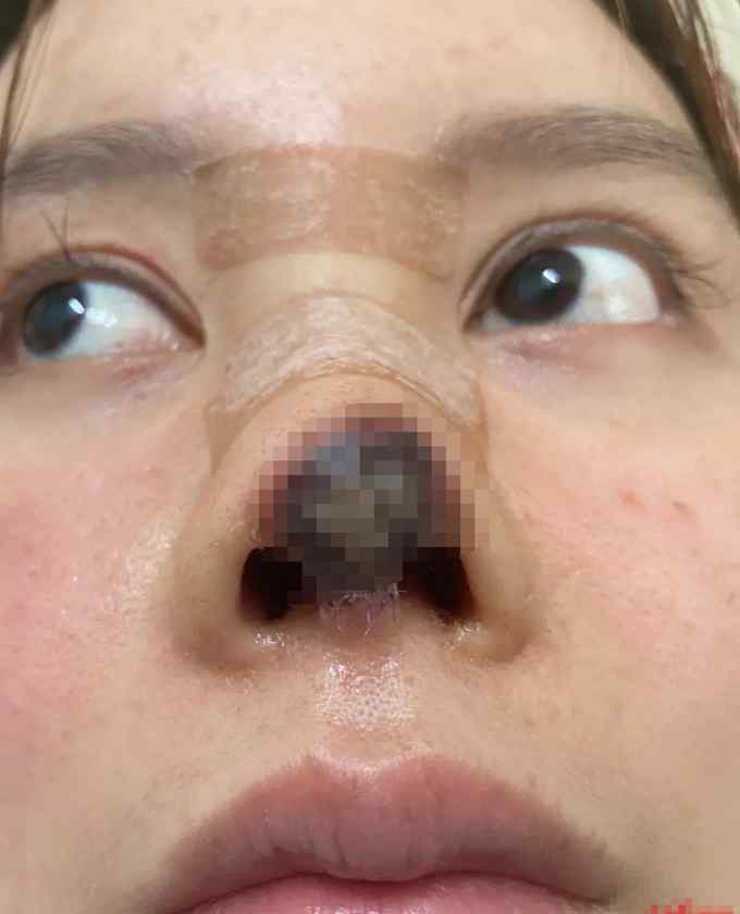 当地卫健局介入高溜整形失败事件 自称“鼻头坏死后曾想跳楼轻生”
