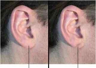 耳朵有折痕预示 “耳朵褶皱”是冠心病迹象？符合这5点的人心脏更危险