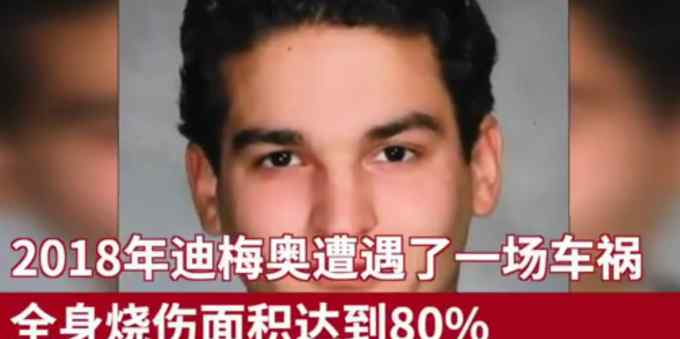 奇迹！全球首例成功换脸换手手术 如今可以自己穿衣吃饭