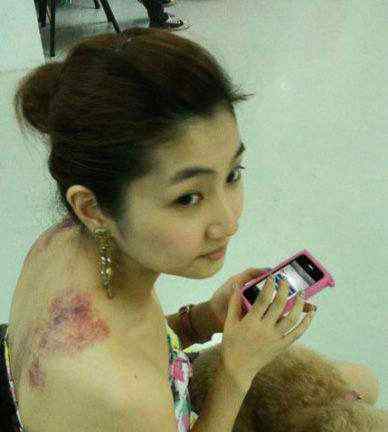 selina下面烧伤 Selina谈烧伤事件说“没必要走出来”，曾被前夫嫌弃“看了想吐”