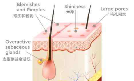 皮肤油脂分泌旺盛怎么办 皮肤爱出油怎么办？ 为什么低碳饮食可以逆转“大油皮”？