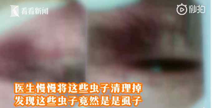 女子睫毛根部长40多只吸血虫 密密麻麻还在动
