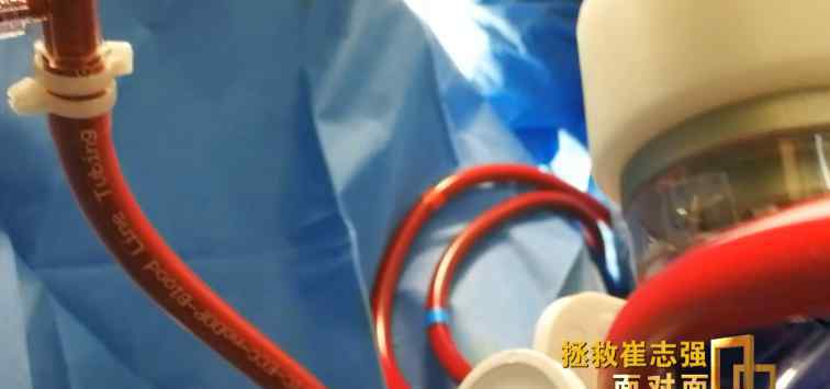 险象迭生 险象迭生！全球首位新冠肺移植出院患者救治过程公开