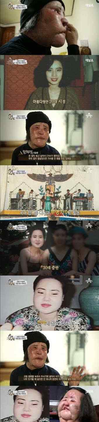 整容失败女星有哪些女星整容失败丧命毁容悲惨案例