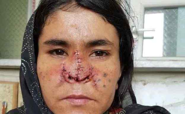 28岁女孩被丈夫割掉了鼻子和耳朵 却不敢离婚