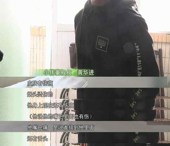 男童遭亲父烟头烫伤双手面临截肢