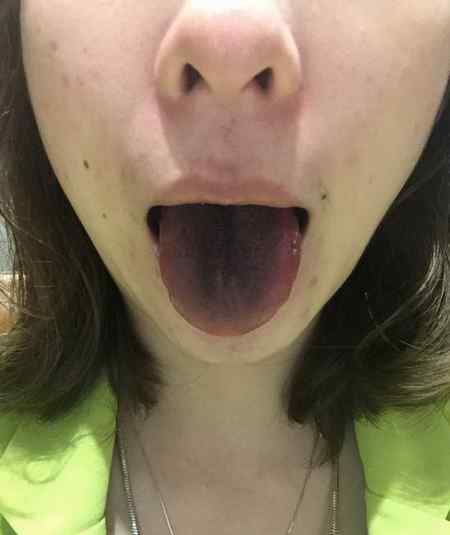 吃火锅拉肚子什么原因 吃火锅舌头变黑 食客：回家后和朋友都拉肚子了，隔天还在拉