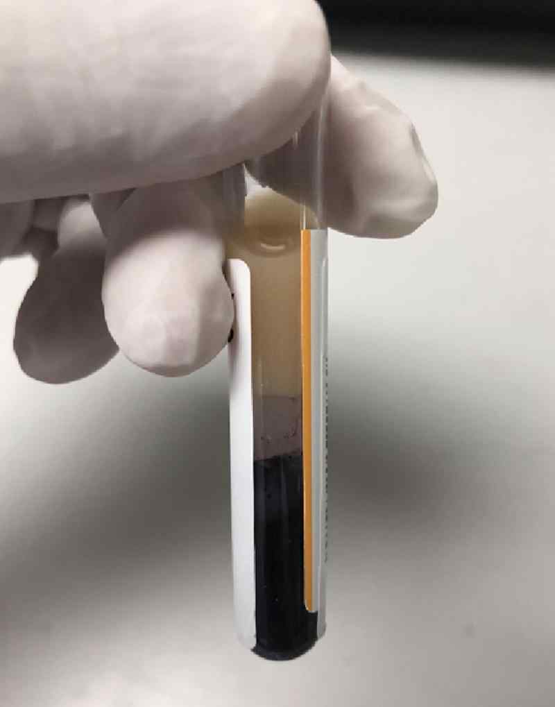 吓懵了！170斤男子吃猪蹄牛杂进ICU 抽血竟是粉红色...