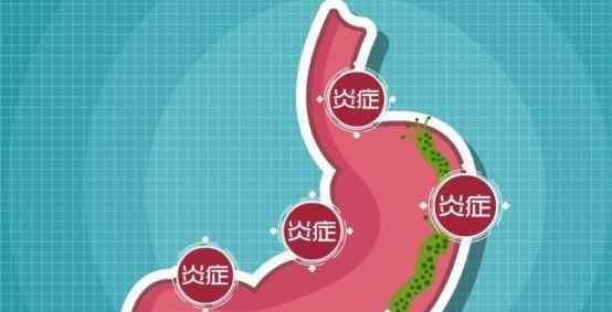 幽门螺杆菌的克星食物 终于找到幽门螺旋杆菌的“克星”，常吃可以养胃抑菌，暖胃消炎！