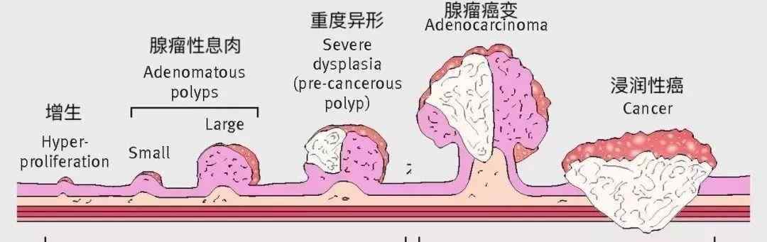 肠子里有息肉的症状是什么 这种息肉，十有八九会癌变！千万别小病拖成大病