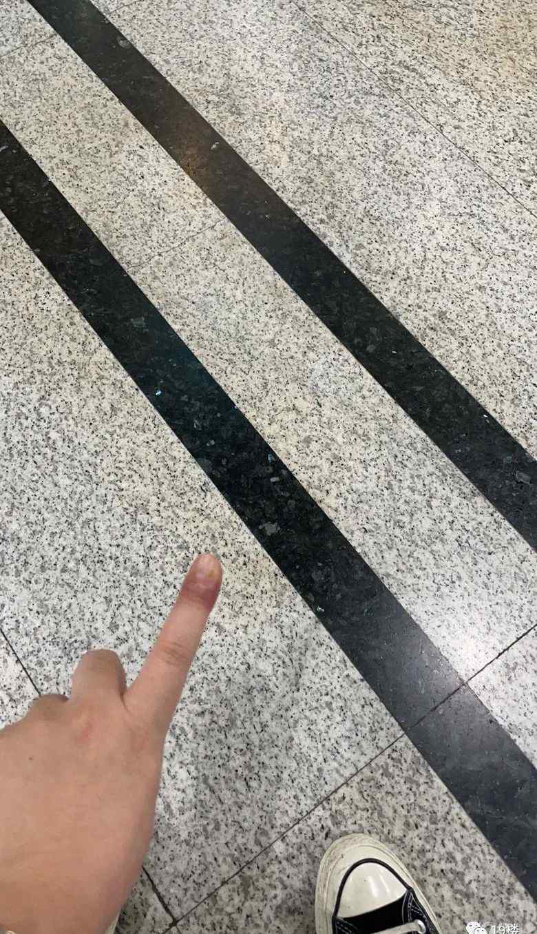 邓萃雯拔倒刺发炎入院手术 医生紧急提醒：莫乱拔！有人曾被迫截肢