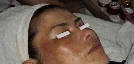 女人为什么会长黄褐斑 女性长斑，脸色暗沉是肝火旺的表现，中医2个小方子，色斑慢慢消