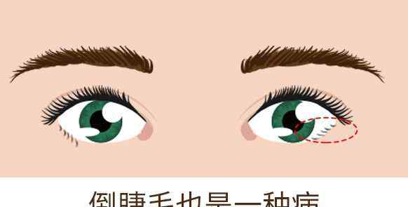 睫毛进眼睛里会溶解吗 睫毛为什么会长进眼睛里，该怎么办呢？