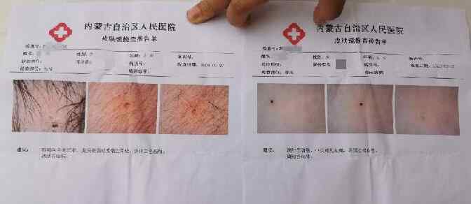 幼儿身上现针眼案:3涉案教师被捕 到底发生了什么