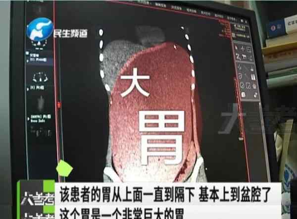 女子一顿饭喝3升奶茶吃10个包子30根雪糕 医生称头回见