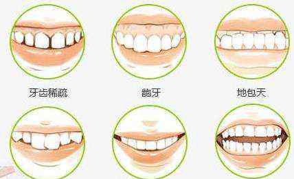 矫正多少钱 牙齿矫正多少费用？文章配图