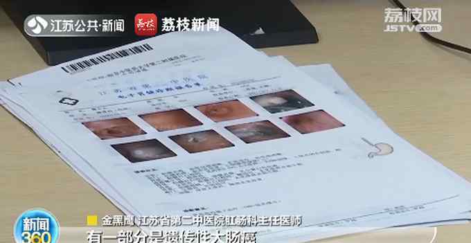 超9成大肠癌源于息肉癌变