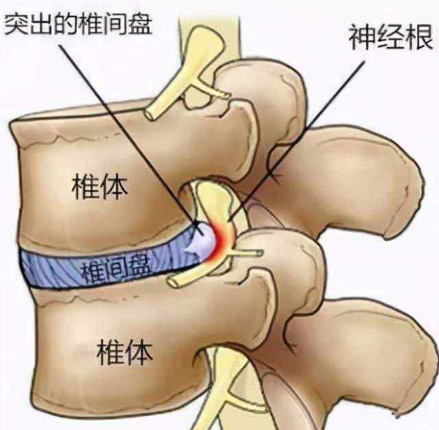 腰椎间盘突出人工腰椎 腰椎间盘突出80%-90%不需要手术，可以这样治....